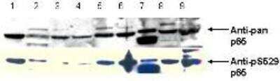 Western Blot: RelA/NFkB p65 [p Ser276] Antibody [NBP1-77807] - pS529 shows phospho p65 staining in carcinoma cells.